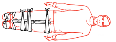 Avoid making any ties over the site of the fracture